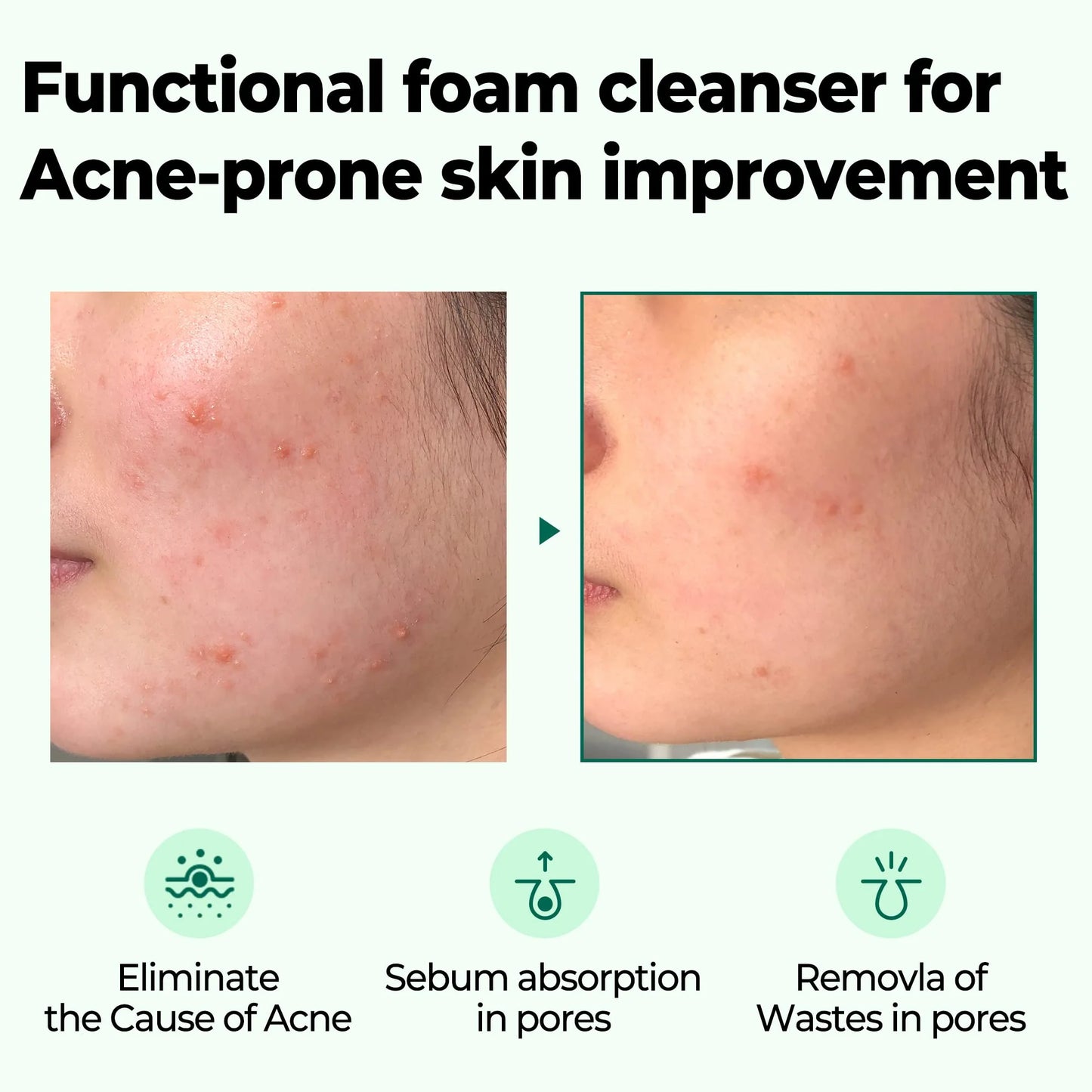 Some By MI- AHA BHA PHA 30 Days Miracle Acne Clear Foam -100ml