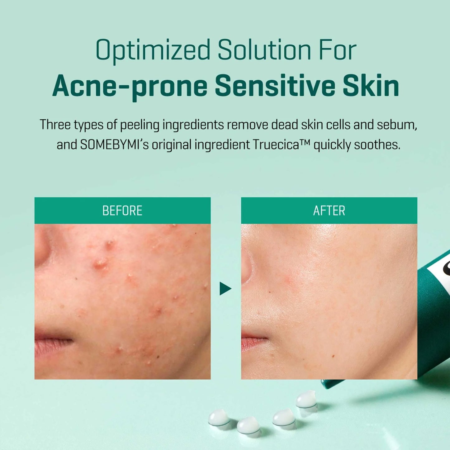 SOME BY MI 14 Days Miracle Cream | Acne Spot Treatment